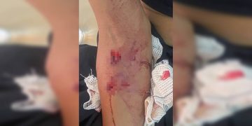 Imagens fortes: veja lesões de mulher atacada por seis cães de rua