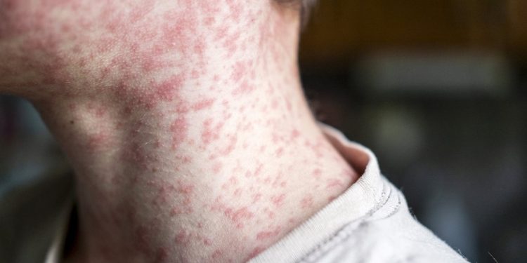 Alarme contra o sarampo nas Américas: mais de 10 mil casos e 18 óbitos