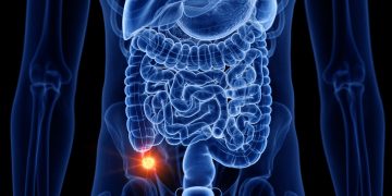 Câncer que antes era raro tem aparecido mais entre jovens. Saiba qual