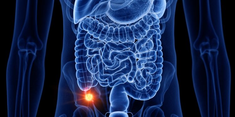 Câncer que antes era raro tem aparecido mais entre jovens. Saiba qual