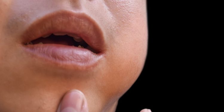 Caxumba desce? Doença pode afetar a fertilidade em homens e mulheres