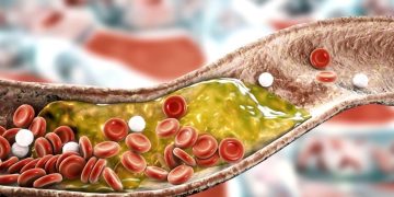 Nova diretriz da SBC estabelece limites mais rígidos para colesterol