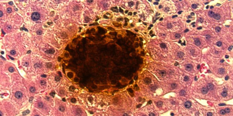 1º transplante com terapia inovadora para diabetes é realizado nos EUA