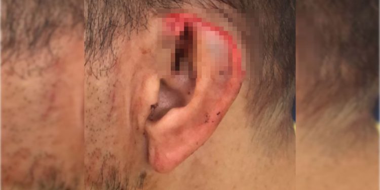 Homem arranca parte da orelha do namorado durante briga no DF