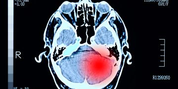 Desordem em anéis de DNA revela pistas sobre câncer cerebral agressivo