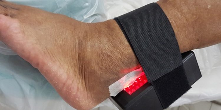 Dispositivo criado por pesquisadora da UnB ajuda a evitar amputações
