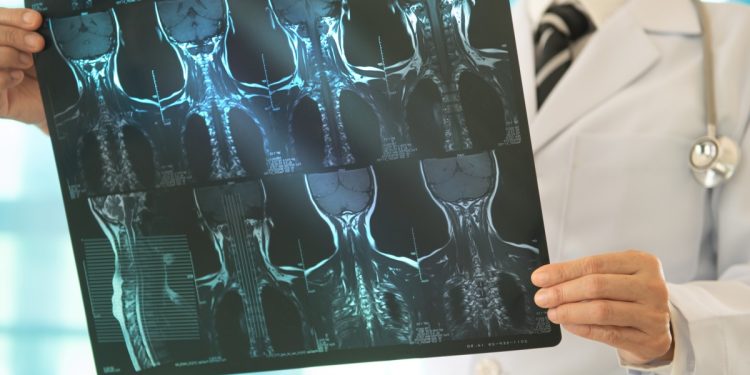 Gordura e massa muscular podem prolongar vida de pacientes com câncer