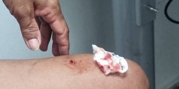 Vídeo: mulher é atacada e mordida por macaco na Água Mineral