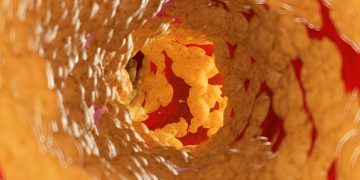 Cardiologista explica o que acontece no corpo quando artérias entopem