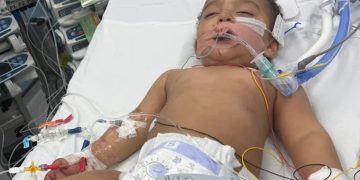 Bebê perde metade da língua após confundir soda cáustica com leite