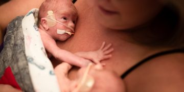 Prematuridade: veja riscos e cuidados essenciais para proteger o bebê
