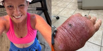 Corte com papelão infecciona e leva mulher de 63 anos ao hospital