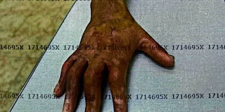 O desfecho do caso de eletricista queimado ao levar choque no Metrô-DF