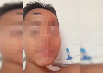 Menino de 11 anos espancado por gangue no lugar do irmão recebe alta