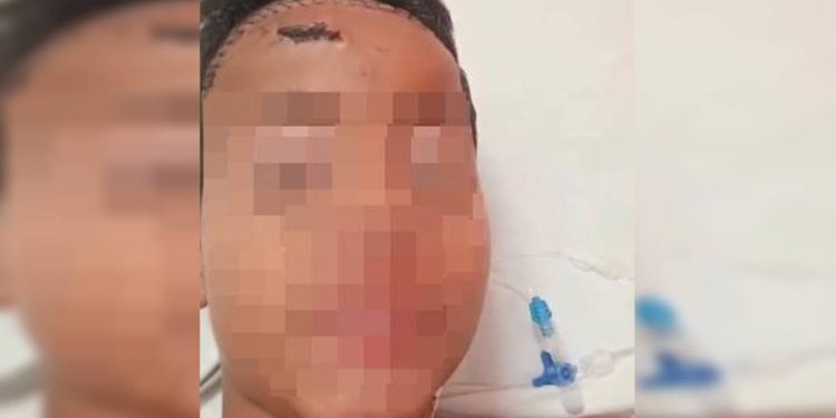 Menino de 11 anos espancado por gangue no lugar do irmão recebe alta
