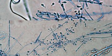 Alta em casos de superfungo que causa lesões na virilha acendem alerta