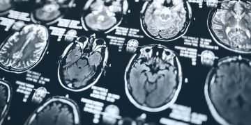 AVC: cardiologistas explicam como a dieta atua na prevenção do derrame