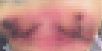 Mulher que teve seios necrosados denuncia médico do DF por erro