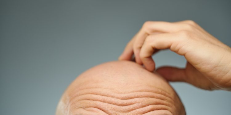 Eles também merecem: saiba como cuidar da pele da cabeça dos carecas