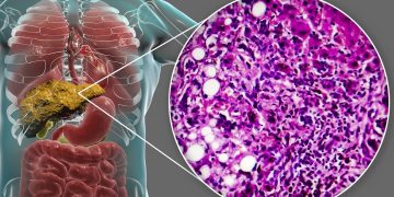 Como a gordura se acumula no fígado e onde ela se instala no órgão