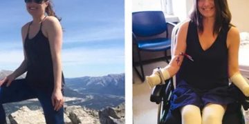 Infecção simples causa choque tóxico e mulher tem 4 membros amputados