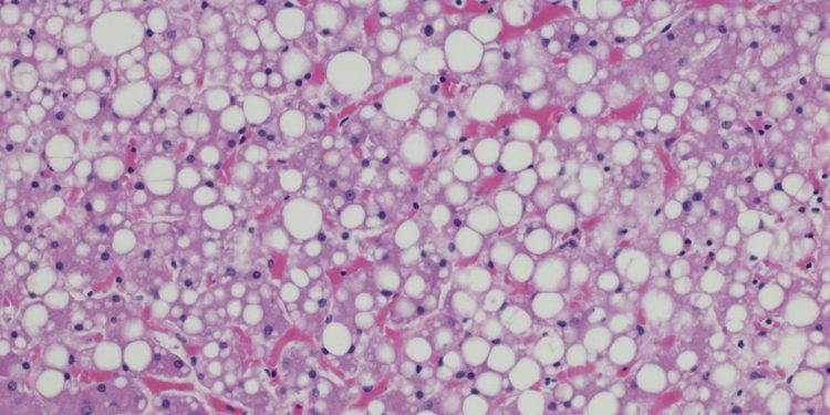 Obesidade: estudo redefine conhecimento sobre metabolismo de gorduras