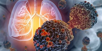 Como funciona 1ª vacina do mundo para prevenção do câncer de pulmão