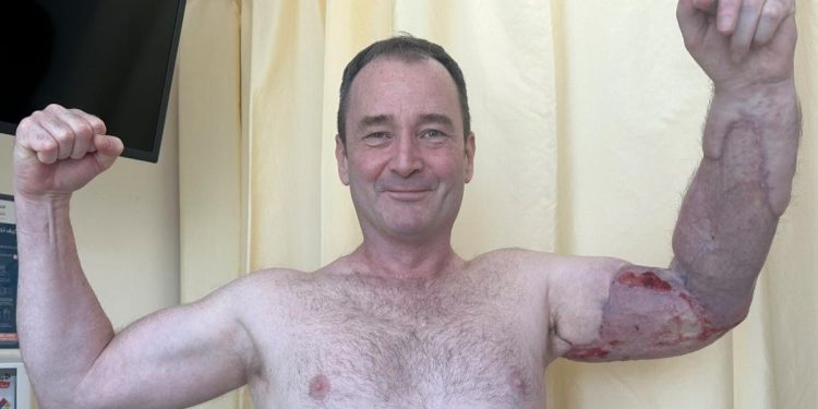 Homem quase perde o braço por bactéria após se machucar na academia