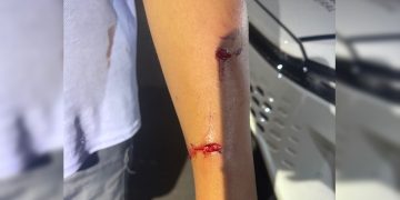 Veja como ficaram criança e policial atacados por pit-bulls no DF