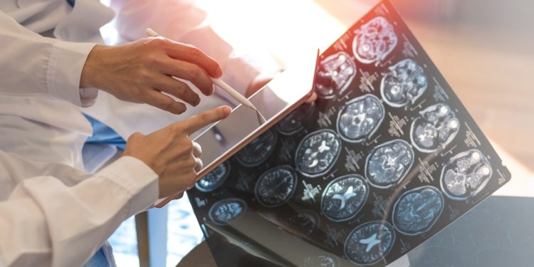 Esclerose múltipla: exame em teste pode adiantar diagnóstico em 7 anos