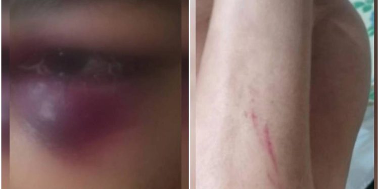 Lesões e olho roxo: mulher é agredida pelo marido por mais de 12 horas