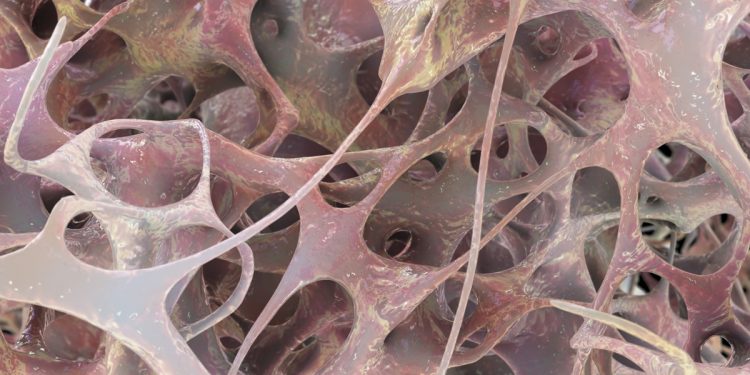 Ortopedista e fisiatra listam os principais sintomas da osteoporose