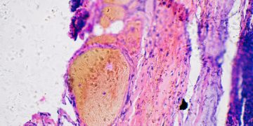 Câncer de pele: oncologista aponta 5 pontos essenciais para prevenção