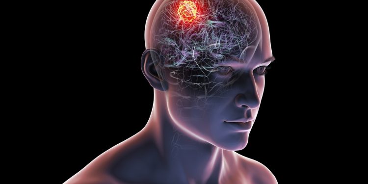 Combinação de suplementos reduz efeitos de tumor cerebral agressivo