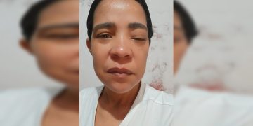 Mulher com olho sangrando tem tratamento negado mesmo com garantia de liminar
