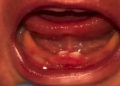 Bebê de Rondônia nasce com dentes e passa por cirurgia para retirá-los