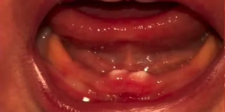 Bebê de Rondônia nasce com dentes e passa por cirurgia para retirá-los