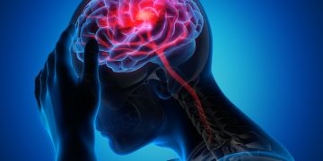 Neurologistas explicam quais são as sequelas mais comuns do AVC