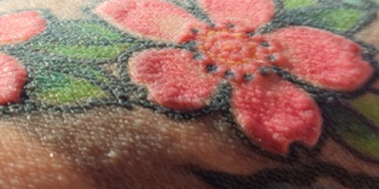 Homem tem alergia após fazer tatuagem vermelha e passa por 7 cirurgias