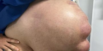 Com hérnia abdominal, homem fica com barriga enorme: “Cresceu em 1 mês”