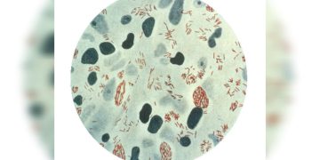 Brasil registra 22 mil casos ao ano de hanseníase. Conheça a doença