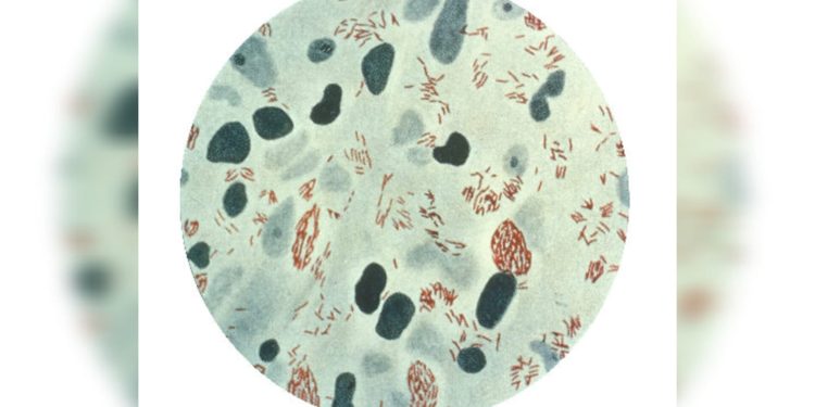 Brasil registra 22 mil casos ao ano de hanseníase. Conheça a doença