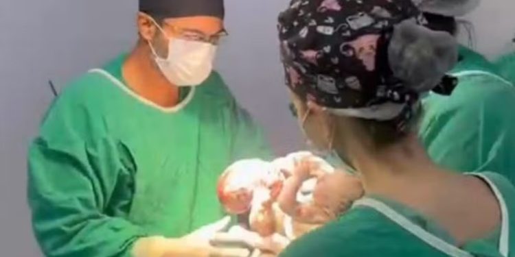 Morre Mateus, segundo gêmeo siamês, após cirurgia de separação