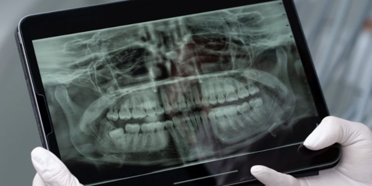 Saliva artificial à base de cana pode proteger dentes na radioterapia