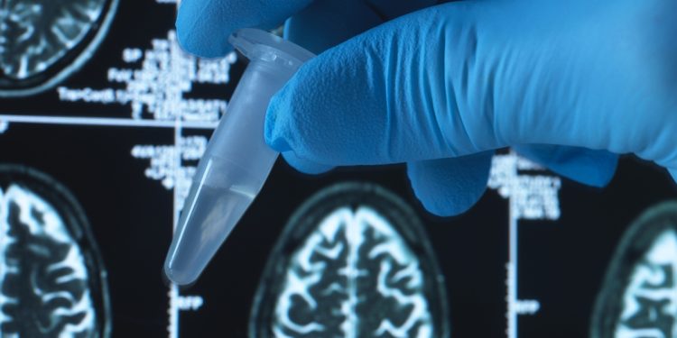 Proteína do câncer pode proteger contra o Alzheimer, sugere estudo