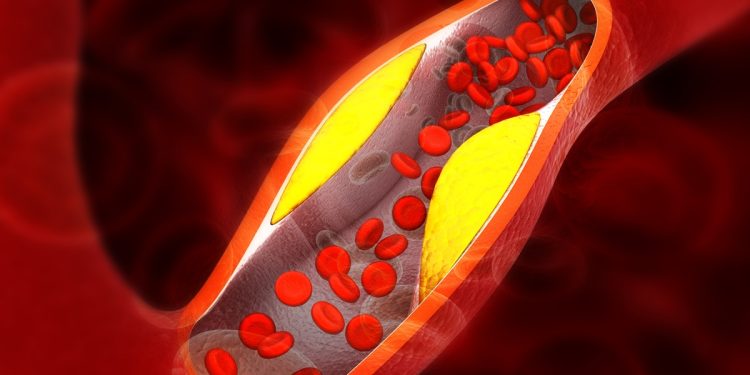 Cardiologistas explicam os principais sintomas de gordura nas artérias