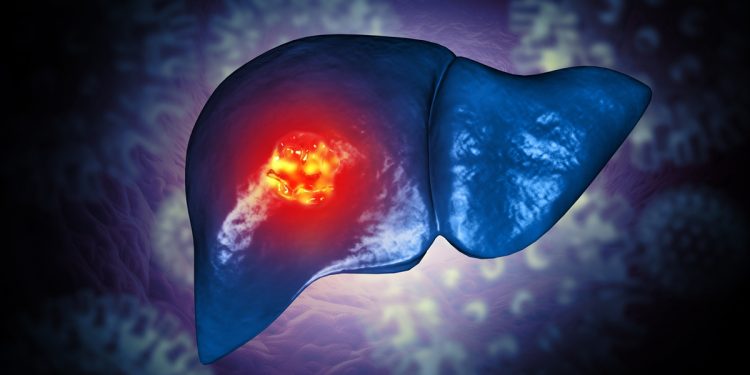 Oncologista indica quais são os sintomas iniciais de câncer no fígado