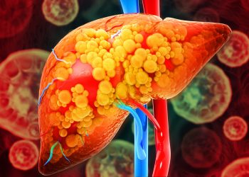 Hepatologista lista os 6 principais sintomas de gordura no fígado