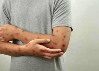 Mpox: DF tem 80 doses da vacina; saiba quem pode receber o imunizante