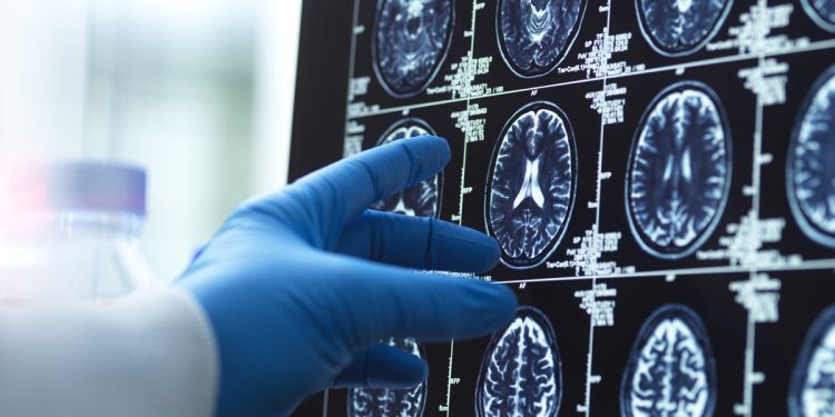 Geriatra lista 5 melhores hábitos para diminuir o risco de Alzheimer